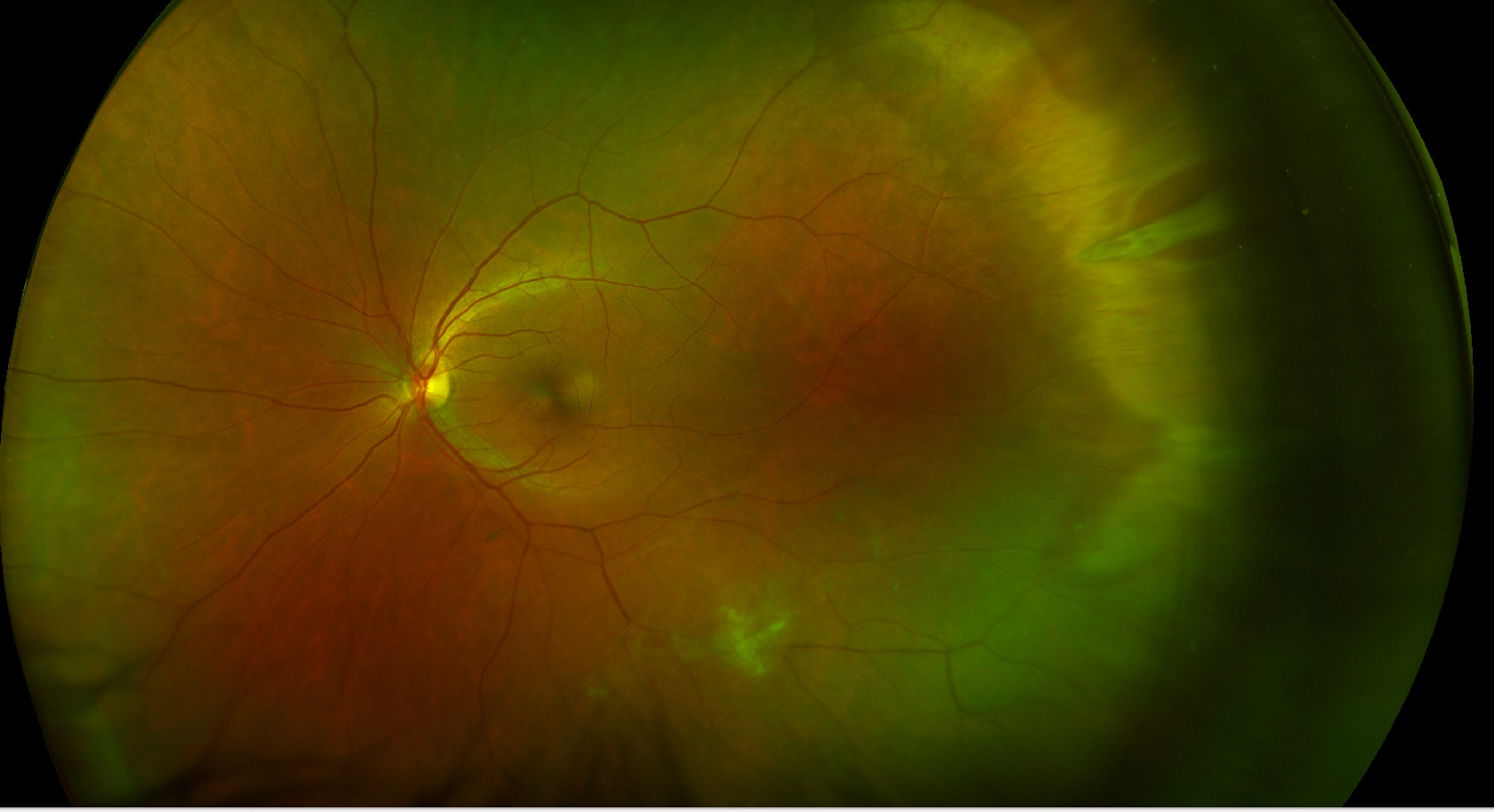 Tratamento da Retina - Instituto de Moléstias Oculares